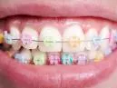 Cores de Aparelhos Dentários que Mantêm a Intensidade ao Longo do Tempo
